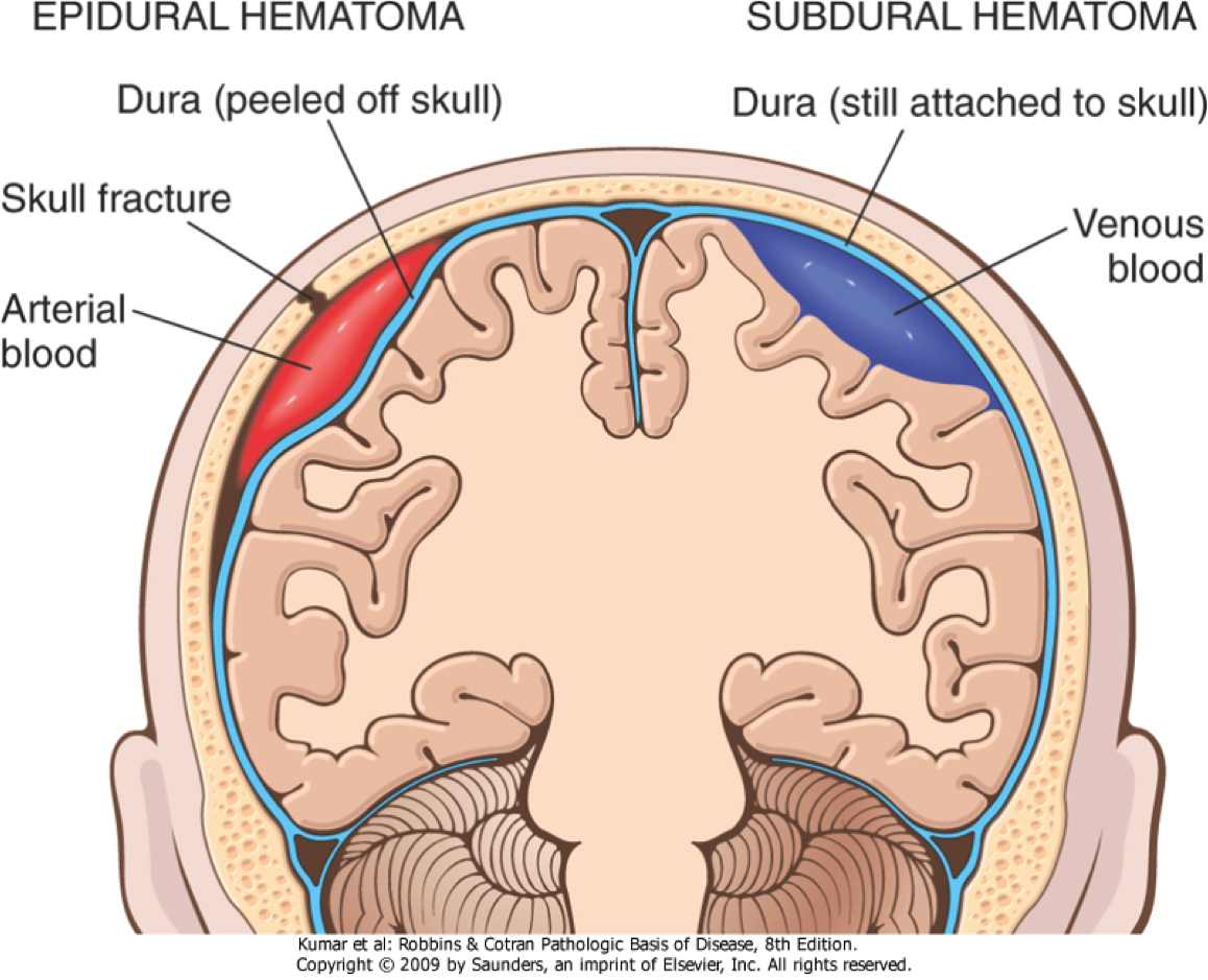 epidural and subdural hematoma