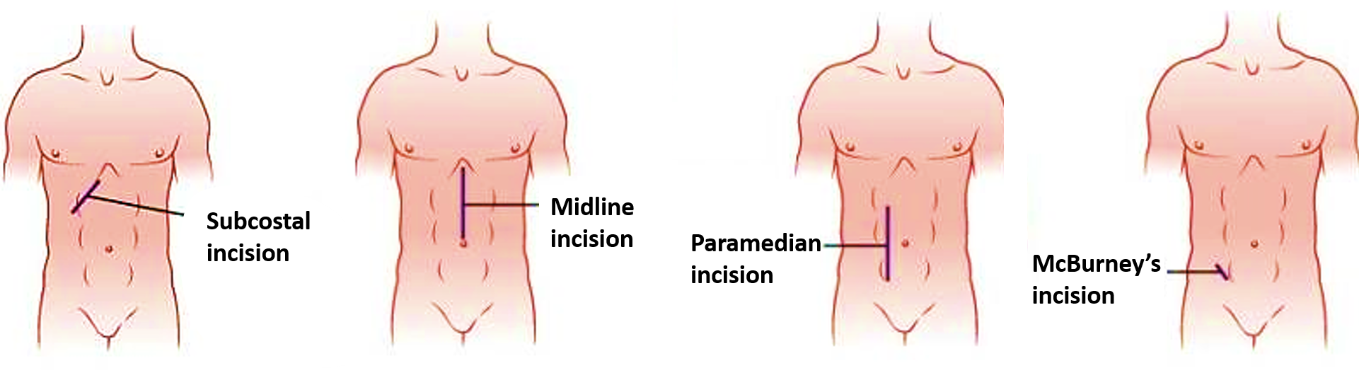 main abdominal incisions