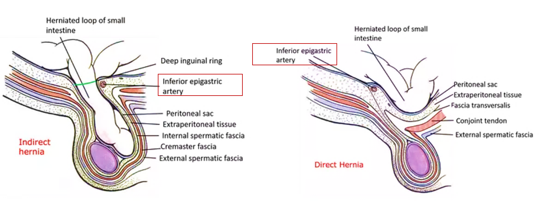 direct and indirect inguinal hernias