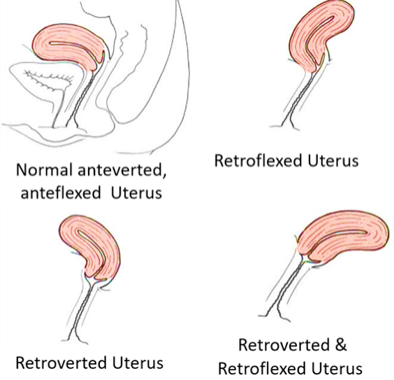 abnormal position of uterus