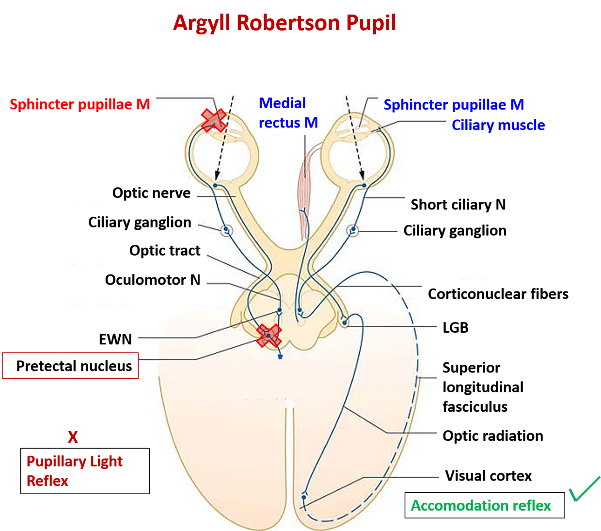 Midbrain anatomy - Argyll robertson pupil