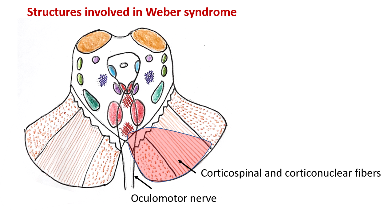 midbrain anatomy - Weber syndrome