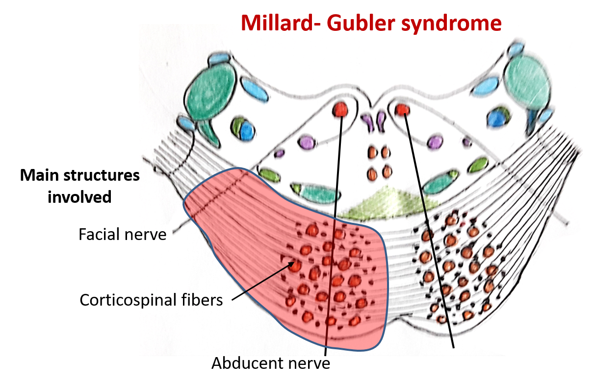 Pons anatomy - Millard Gubler syndrome