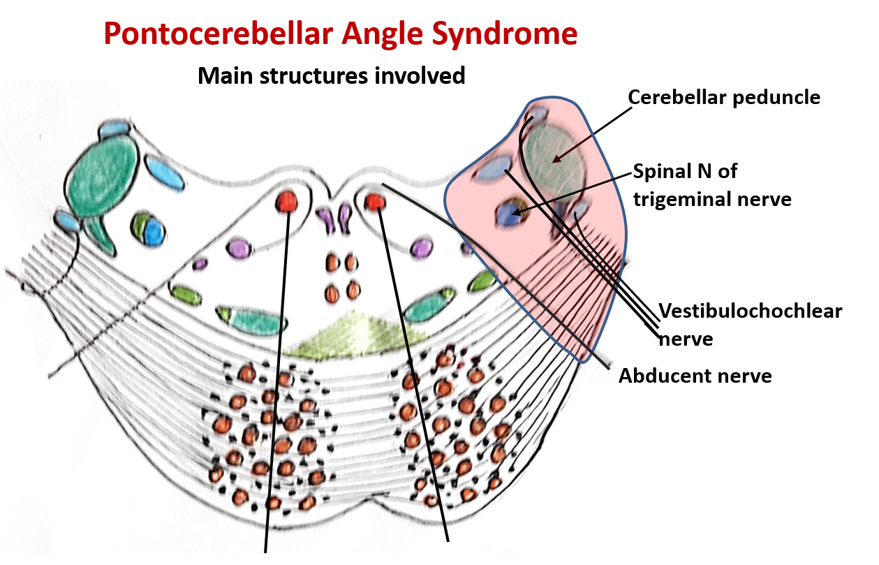 Pons anatomy - Pontocerebellar angle syndrome