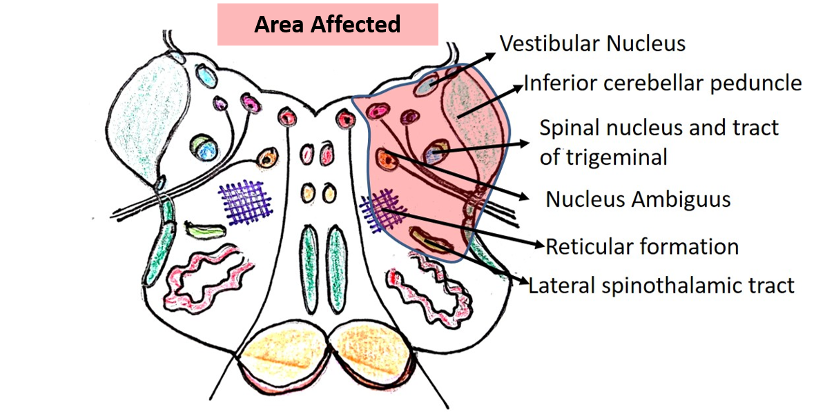 structures affected in lateral medullary syndrome