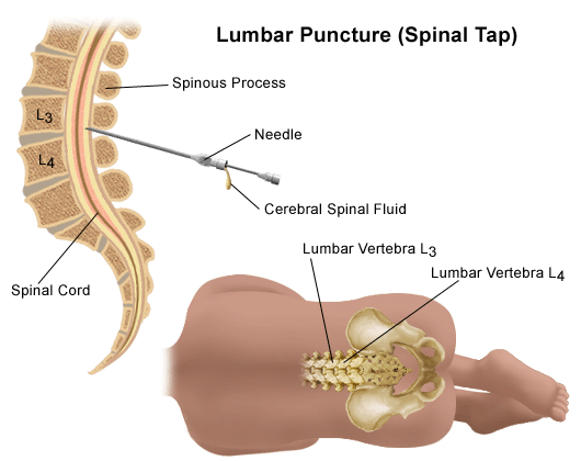 Lumbar puncture site