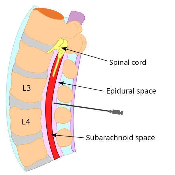 anatomical basis of epidural anaesthesia