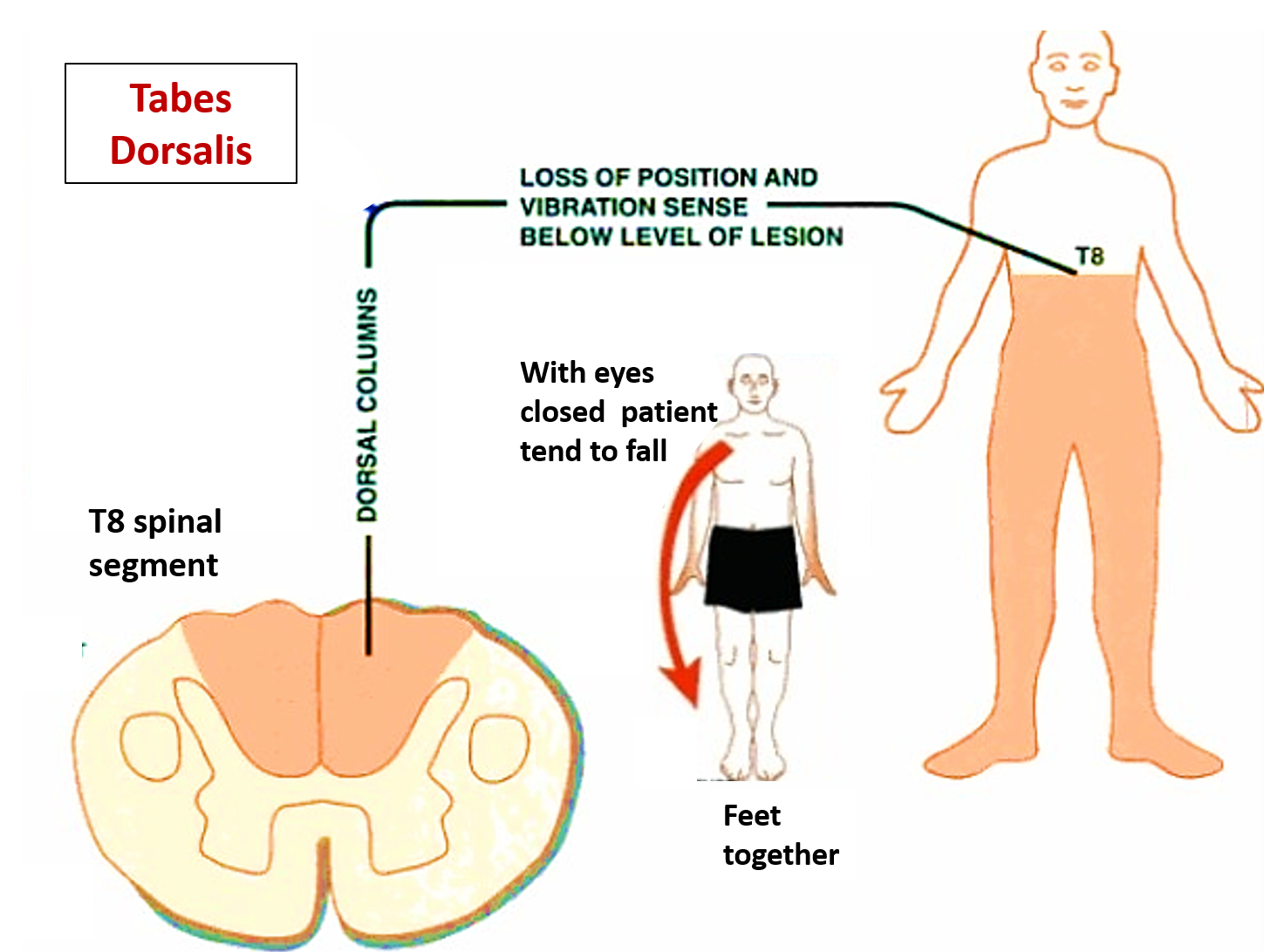 Tabes dorsalis- symptoms and anatomical basis