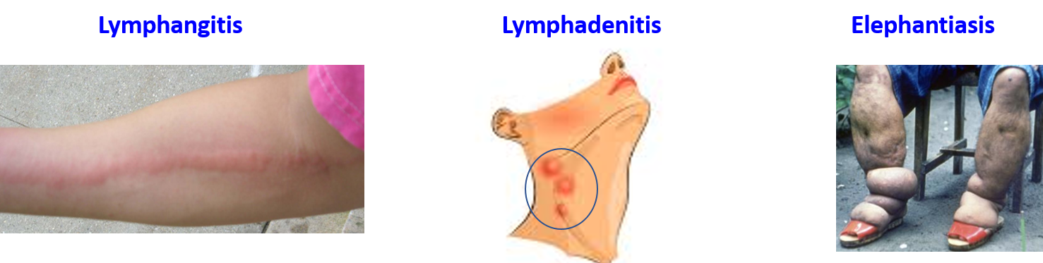 abnormalitis of lymphatic drainage
