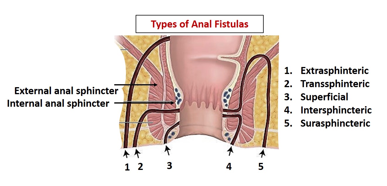 Anal fistulas