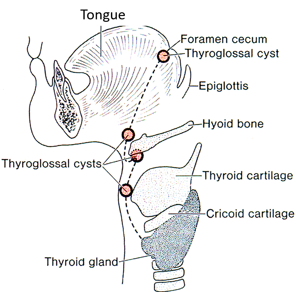 Thyroglossal cysts