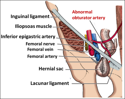 abnormal obturator artery