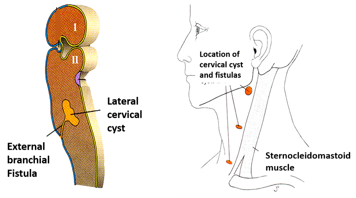 cervical sinus or cyst or fistula