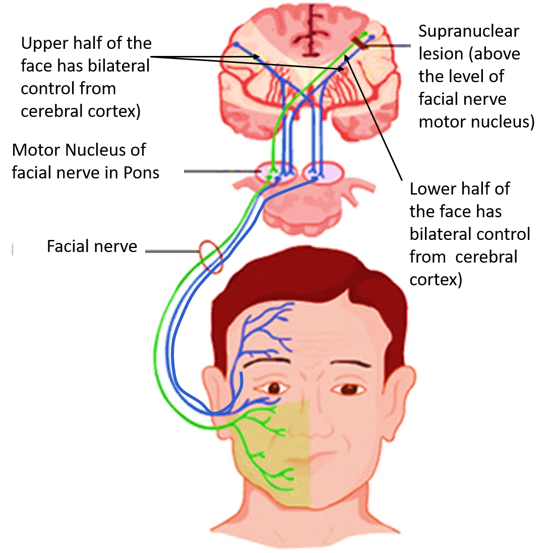 facial nerve- supranuclear lesion