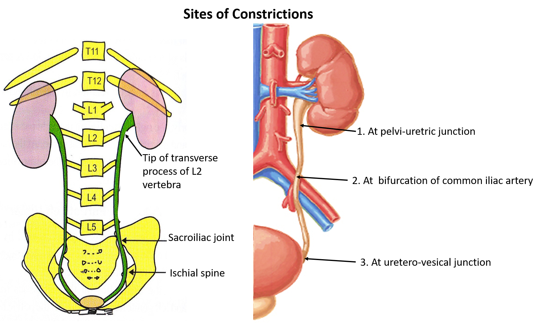 Ureter - sies of constriction